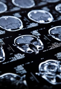 Traumatic Brain Injury