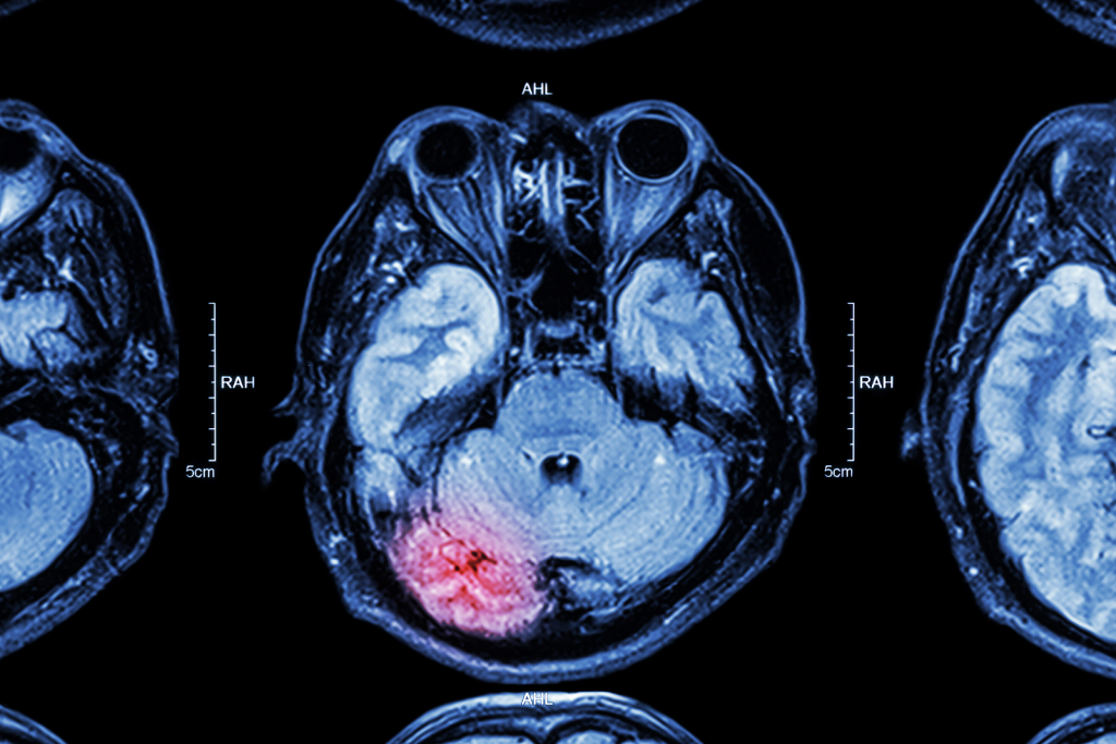 MRI of an injured brain. TryMunity