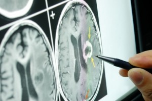 Traumatic Brain Injury