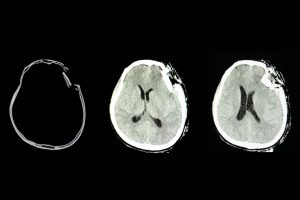 Difference Between TBI and ABI